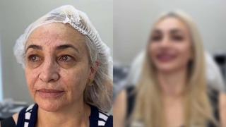 Estetikle değişimin bu kadarı da pes dedirtti! Neredeyse 30 yaş gençleşti