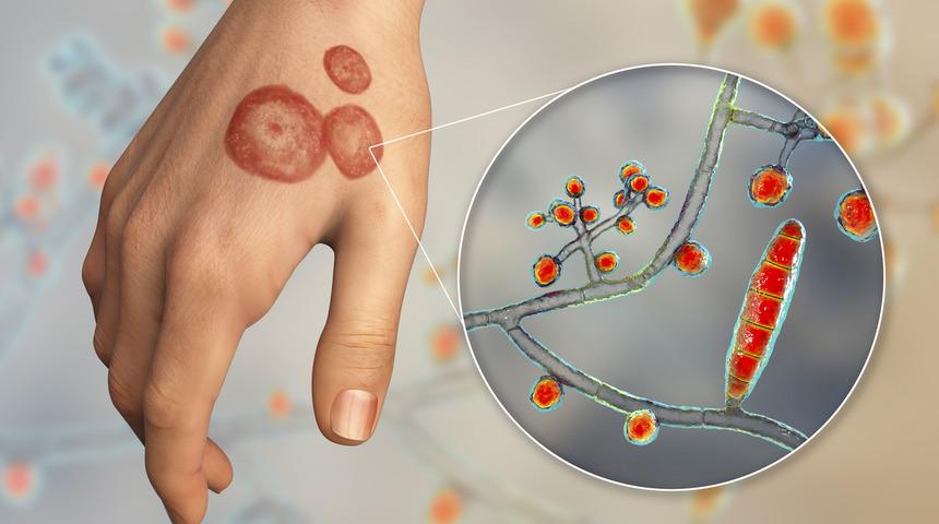 Vakalarda şaşırtan artış! 'Yeni tanımlanan 1-2 tip var' Gençlerde de görülmeye başladı! Tedavi edilmezse yıllarca devam ediyor