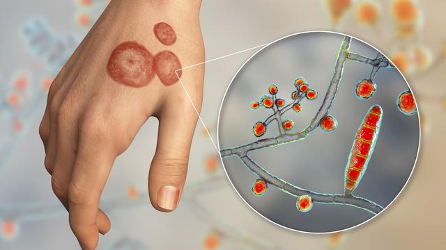 Vakalarda şaşırtan artış! 'Yeni tanımlanan 1-2 tip var' Gençlerde de görülmeye başladı! Tedavi edilmezse yıllarca devam ediyor