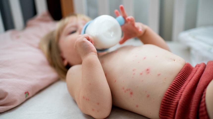 Suçiçeği belirtileri ve tedavisi: Suçiçeği nasıl belli olur, kaç gün sürer, nasıl geçer?