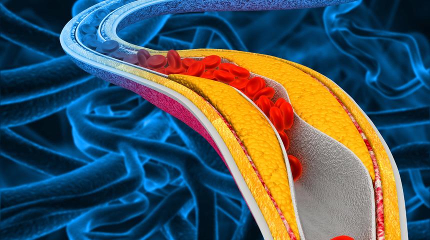 Damar tıkanıklığı belirtileri nelerdir? Damar tıkanıklığı nasıl fark edilir?