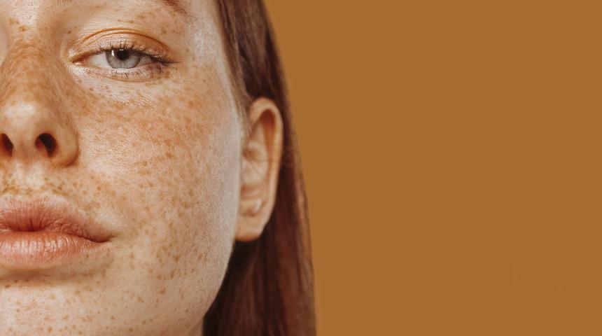 Çillerinden kurtulmak istiyorsan bu 3 şeyi yap! 