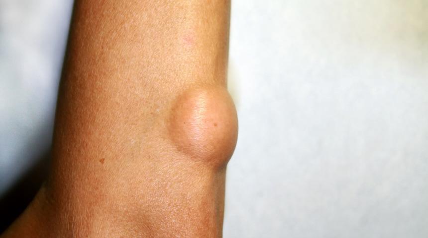 Kanserli yağ bezesi belirtileri nelerdir? Yağ bezesinin kanser olduğu nasıl anlaşılır?