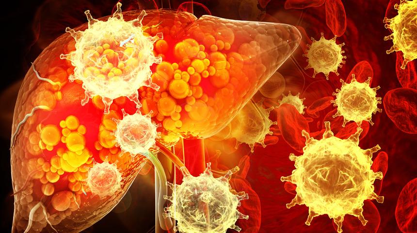 Karaciğer kanserinin belirtileri nelerdir? Karaciğer kanseri belirtileri, nedenleri ve tedavisi