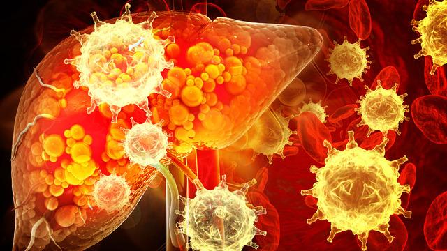 Karaciğer kanserinin belirtileri nelerdir? Karaciğer kanseri belirtileri, nedenleri ve tedavisi