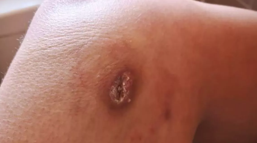 Telefonun şarj cihazı yanında prize takılıyken uyuyakaldı! Bacağında kocaman bir siyah delik oluştu... "Sıradan alışkanlığın bu kadar tehlikeli olduğunu bilmiyordum"