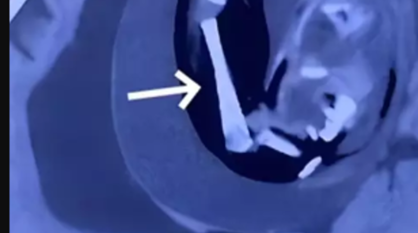 Tıp dünyasını şaşkına çeviren vaka! 1 yaşındaki kızın kafasından fetüs çıktı... "Parazit doğmamış ikiz"