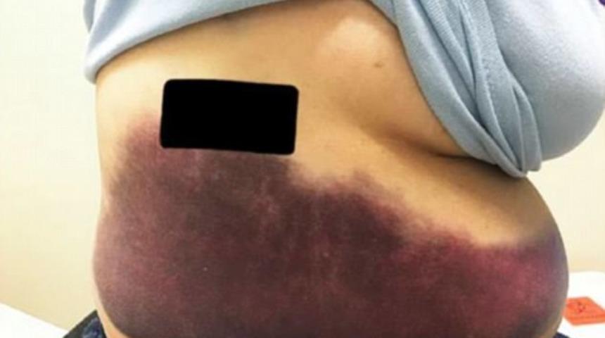 İnanmayacaksınız ama onu bu hale öksürük getirdi