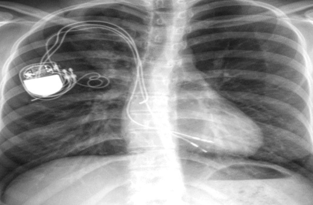 T&uuml;rk hekiminin tedavisi tarihe ge&ccedil;ti! Kalp hastası gen&ccedil; kadını hayata bağlayan m&uuml;dahale &ouml;d&uuml;l aldı