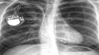 Türk hekiminin tedavisi tarihe geçti! Kalp hastası genç kadını hayata bağlayan müdahale ödül aldı