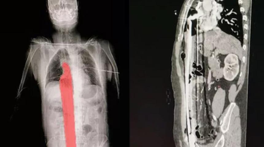 Korkunç olay! İskeleden düşen adamın gövdesinin tamamına demir çubuk saplandı... İç organları delindi