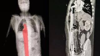 Korkunç olay! İskeleden düşen adamın gövdesinin tamamına demir çubuk saplandı... İç organları delindi