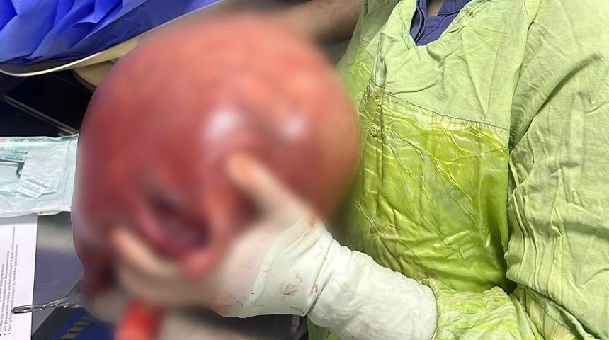 Basit bir karın ağrısı sandı! Vücudundan çıkana inanamadı: Sinsice büyümüş... Tam 5,5 kilo