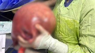 Basit bir karın ağrısı sandı! Vücudundan çıkana inanamadı: Sinsice büyümüş... Tam 5,5 kilo