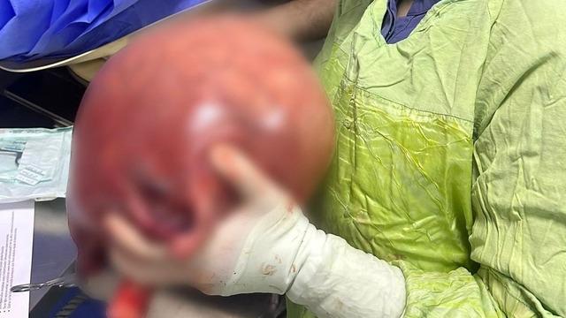 Basit bir karın ağrısı sandı! Vücudundan çıkana inanamadı: Sinsice büyümüş... Tam 5,5 kilo