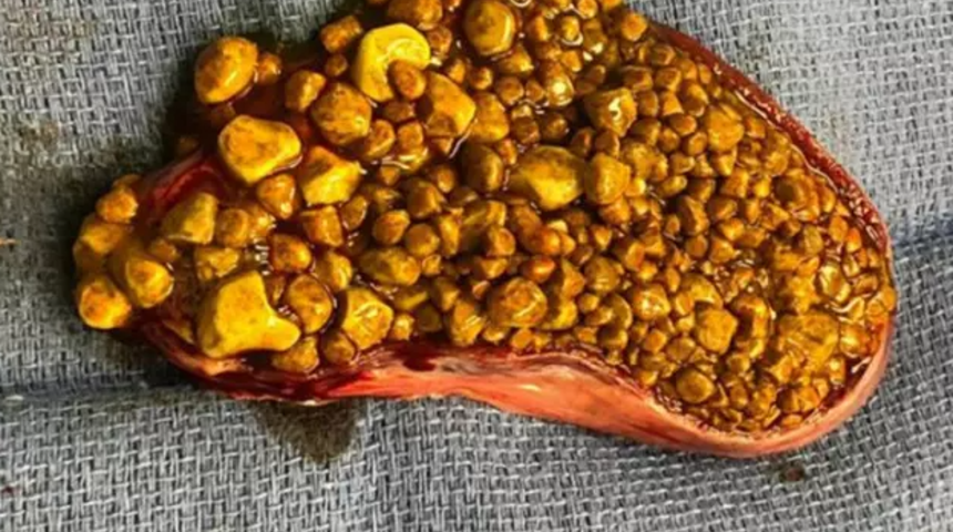 Doktorları şaşkına çeviren vaka! Mide ağrısıyla hastaneye gitti... "5000 safra taşı çıktı"