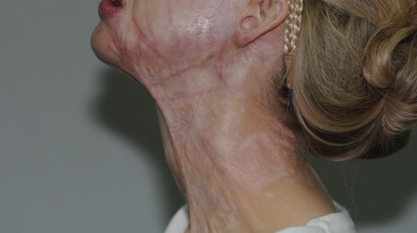 Derin yanık izlerinde artık tedavi m&uuml;mk&uuml;n