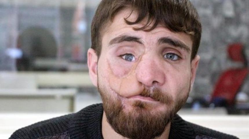 Av tüfeğiyle yüzünü vurdu... 25 yaşında 38 ameliyat geçirdi!