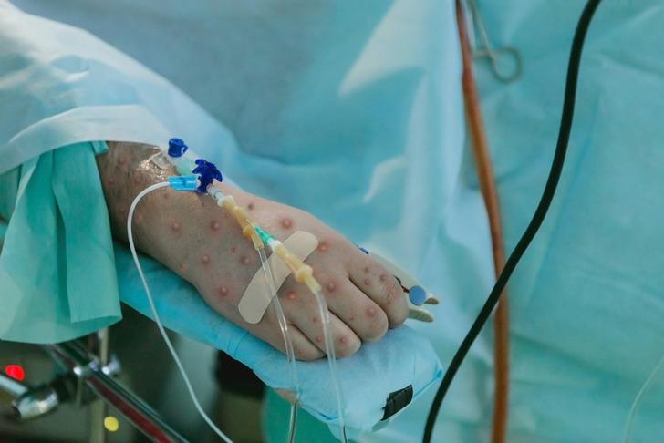 Uzmanından ‘M Çiçeği virüsü' uyarısı: Eldiven kullanımı artacak! 'Komaya kadar gidebiliyor' G3