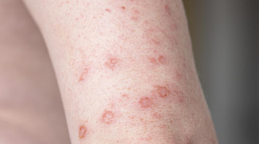 Sierra Leone'de Maymun çiçeği vakaları nedeniyle ‘acil durum’ ilan edildi!