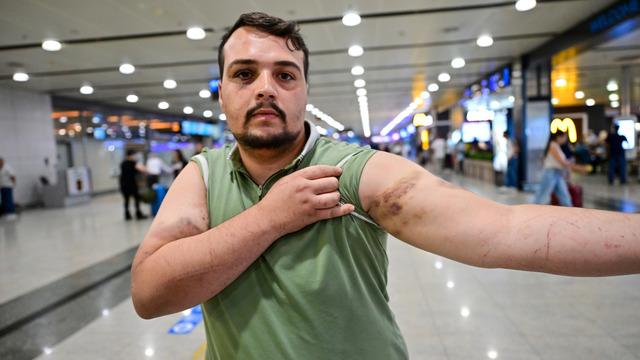 Tatile gittiği yurt dışında fidye için kaçırılan Türk vatandaş vücudundaki izleri gösterdi: Korkup bizi dağ yolunda bıraktılar!