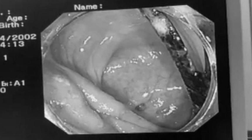 Aylarca geçmeyen mide ağrısından muzdaripti! Bağırsağından plastik çatal çıktı... Doktorlar bile şaşkına döndü