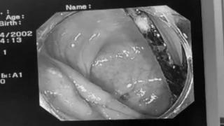 Aylarca geçmeyen mide ağrısından muzdaripti! Bağırsağından plastik çatal çıktı... Doktorlar bile şaşkına döndü