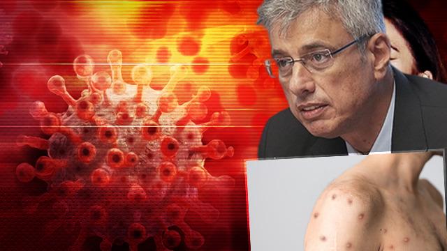 Afrika acil durum ilan etmişti! Sağlık Bakanı Memişoğlu'ndan açıklama geldi: Maymun çiçeği...