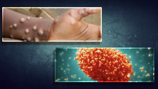 'Derhal adım atılmazsa kontrolden çıkabilir' Alarma geçildi: Yalnızca dokunma yoluyla yayıldığı vakalar da var! 'Başta maymun çiçeğini covid sanmıştım, hiç bu kadar acı çekmemiştim'