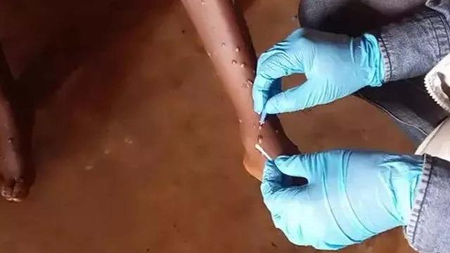 Hindistan'da da Maymun çiçeği virüsü görüldü