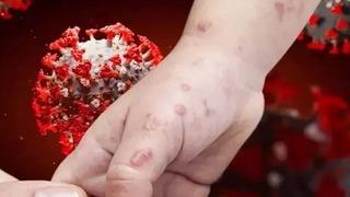 DSÖ'den Maymun çiçeği virüsü için harekete geçti