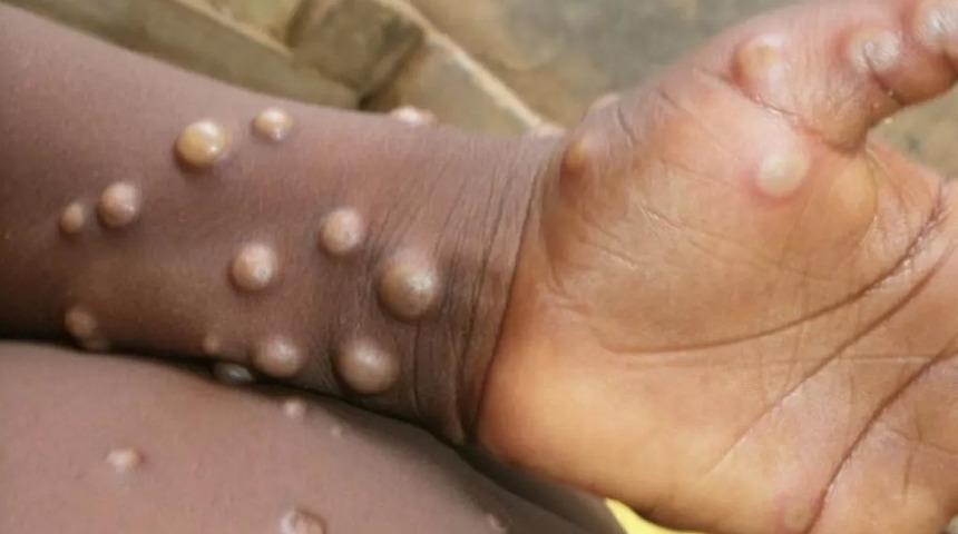 Prof. Dr. Bakır: ''M çiçeği virüsünde paniğe gerek yok''