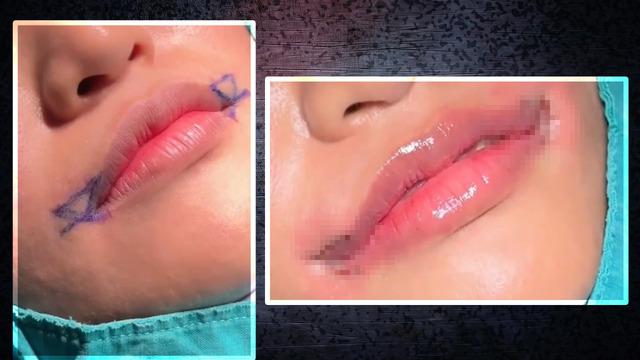 Burun, göz derken şimdi de o çıktı! Barbie gülüş estetiği pes dedirtti