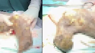 20 yaşındaki gencin midesinden 50 santimlik saç yumağı çıkarıldı! Doktorlar bile şaşırdı: Meğer 15 yıldır saç yiyormuş