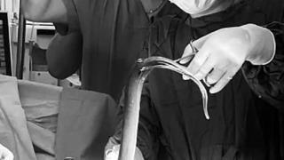 Doktorları şaşırtan olay! Anüsünden 66 cm uzunluğunda yılan balığıyla limon çıktı... Bağırsaklarını parçalayarak dışarı çıkmaya çalışmış