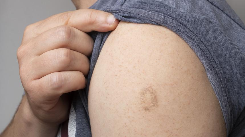 Çiçek aşısı Türkiye'de en son ne zaman yapıldı? En son kaç doğumlular çiçek aşısı oldu? Çiçek aşısı hâlâ yapılıyor mu?