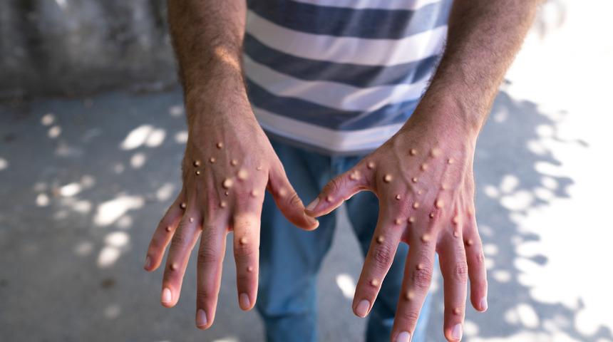 Maymun çiçeği tedavisi var mı? Maymun çiçeği tedavisi nasıl yapılır?