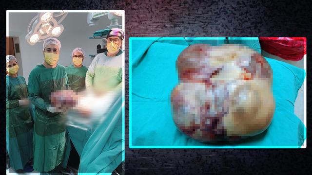 Ameliyattan korkup kaçtı ama... Vücudundan tam 15 kiloluk dev kitle çıktı!