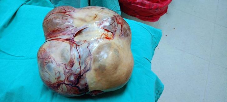 Ameliyattan korkup kaçtı ama... Vücudundan tam 15 kiloluk dev kitle çıktı! G4