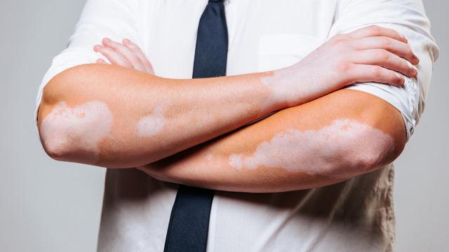 Vitiligo nedir, neden olur? Vitiligo hastalığı geçer mi? Vitiligo belirtileri ve tedavisi