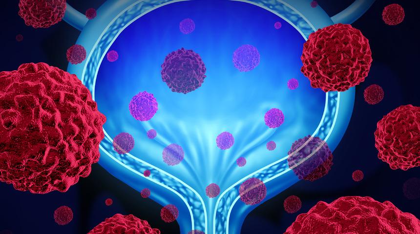 Mesane kanseri belirtileri nelerdir? Mesane kanseri olduğu nasıl anlaşılır?