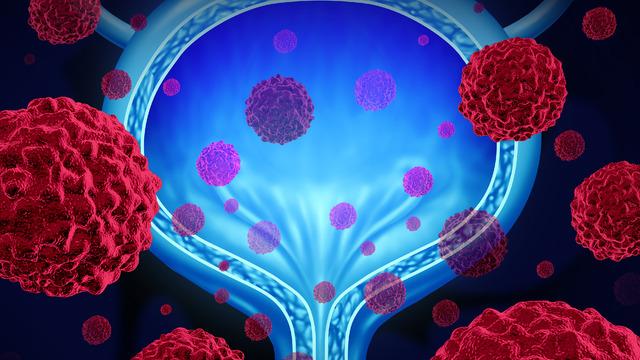 Mesane kanseri belirtileri nelerdir? Mesane kanseri olduğu nasıl anlaşılır?