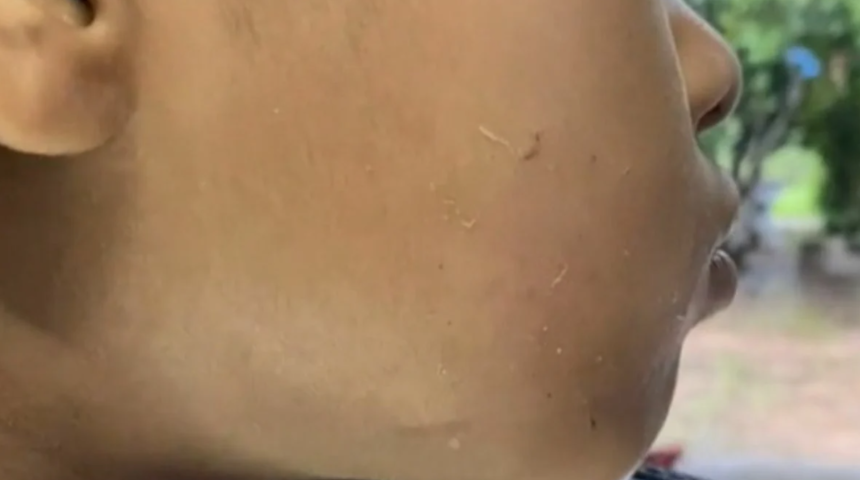 Diş ağrısı çeken küçük yeğenini şifacıya götürdü! Yüzünde solucanlar çıkmaya başladı... "Yanağında delik oluştu"