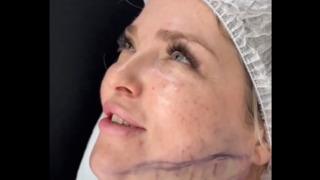 Yaptırdığı estetik operasyonla birkaç saat içerisinde 10 yaş gençleşti