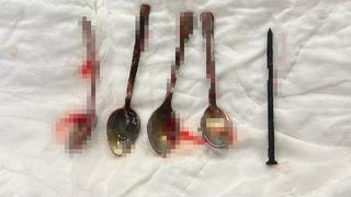 15 yaşındaki çocuğun midesinden çıkanlar hayrete düşürdü