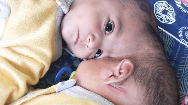 Yapışık olarak dünyaya geldiler! Tam 16 saat sürdü! İkizleri görenler bir daha bakıyor