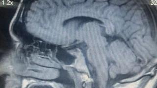 Duyanlar inanamadı! 6 yıl önce trafik kazası geçirmişti... Semptomları yeni ortaya çıktı: Burnunun aktığını düşünen adam beyninin aktığını öğrenince inanamadı