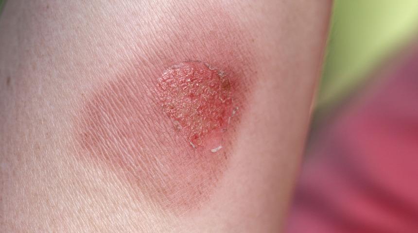 Lezyon nedir? Lezyon nasıl ve neden oluşur?