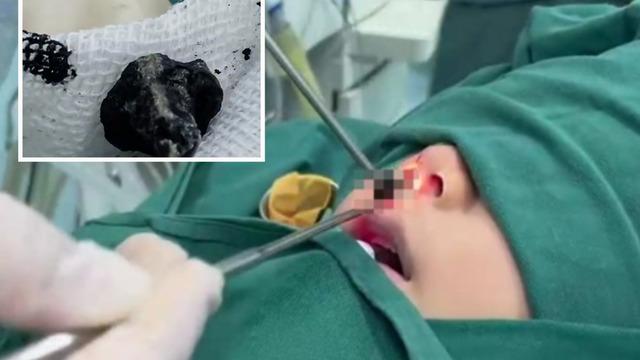 Burnundan kötü kokular gelen 7 yaşındaki çocuk hastanelik oldu! 2 yıldır burundaymış... Ailesi görünce inanamadı: Neredeyse bayılacaktım