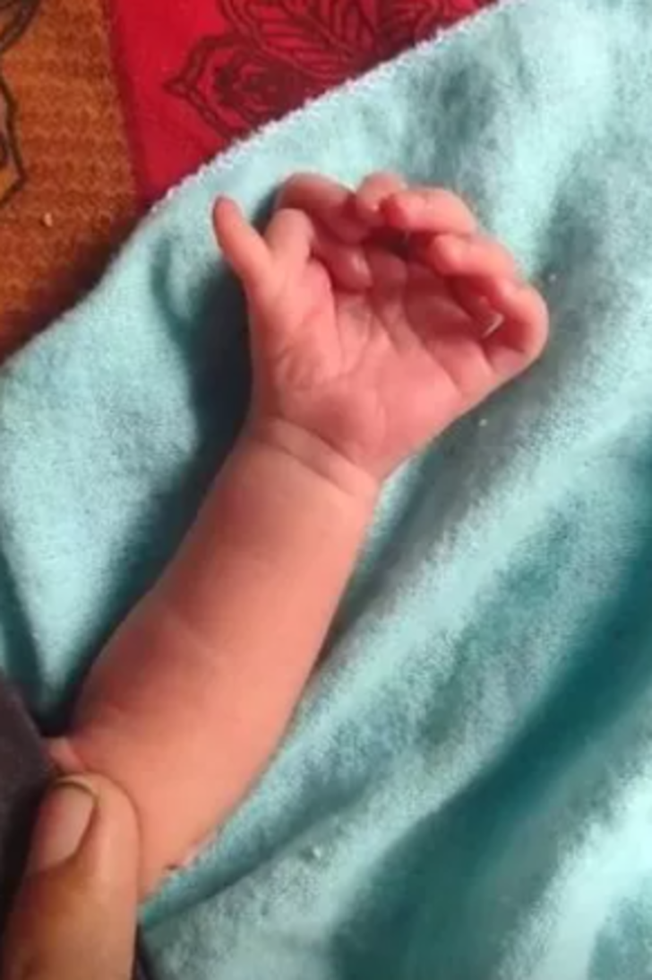 Kendisi küçücük ama etkisi çok büyük! 14 el ve 12 ayak parmağıyla doğan bebek ilan edildi... "Çok mutluyuz" G1